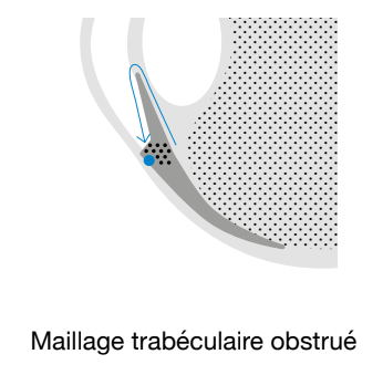 Schéma vision / oeil myope