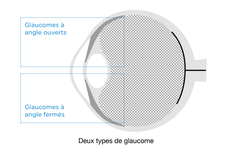 Schéma vision / oeil myope